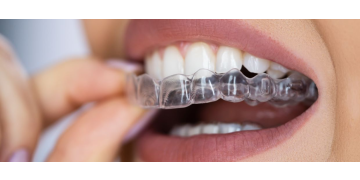 Bruxism: cum sa-l recunosti si ce optiuni de tratament exista?