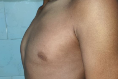 Pectus carinatum